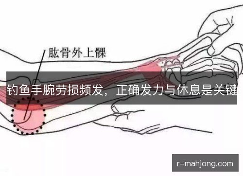 钓鱼手腕劳损频发,正确发力与休息是关键 钓鱼手腕劳损频发,正确发力与休息是关键